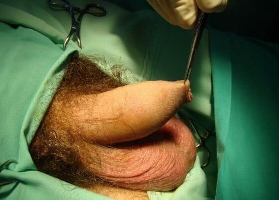 операција повећања пениса
